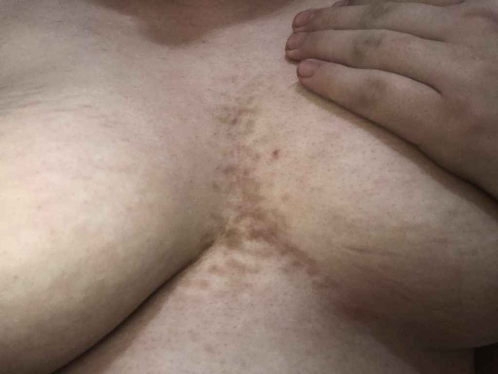 TMI Does anyone else have dark spots in between their breasts